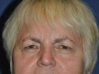 before brow lift female patient front view case 3532