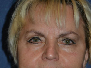 after brow lift female patient front view case 3532