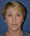 after brow lift female patient front view case 3564
