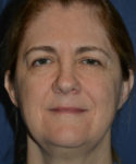 before brow lift female patient front view case 3547