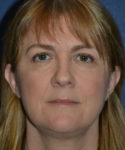 after brow lift female patient front view case 3547