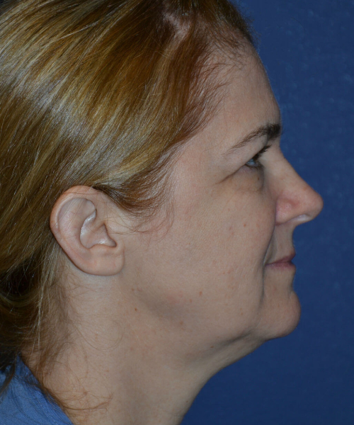 before brow lift female patient right side view case 3547