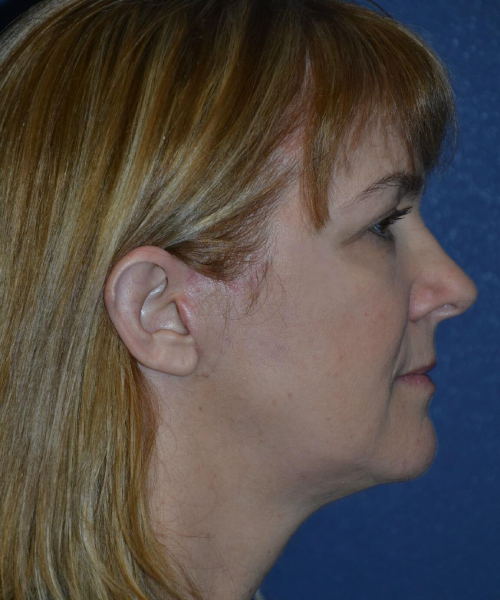 after brow lift female patient right side view case 3547