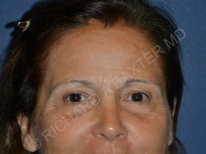 before brow lift female patient front view case 3542