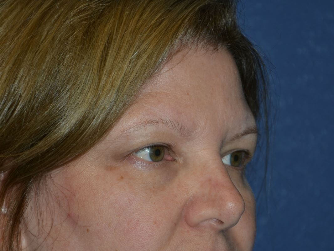 before brow lift female patient right angled view case 3537