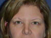before brow lift female patient front view case 3537