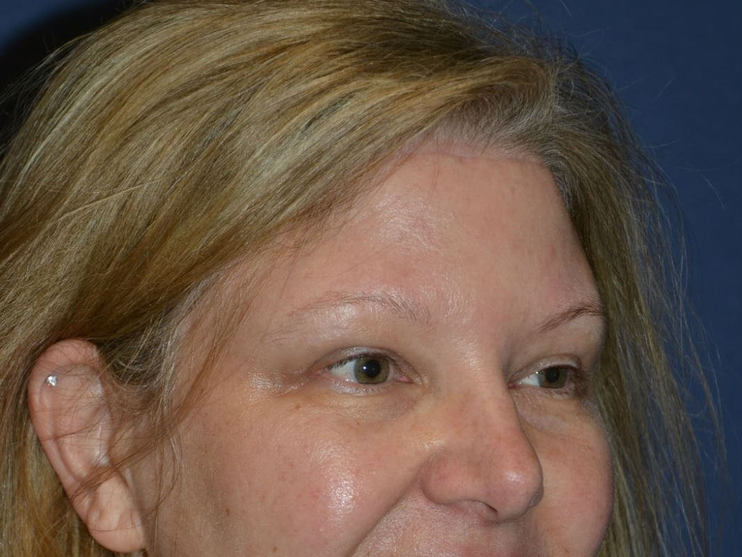 after brow lift female patient right angled view case 3537