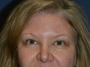 after brow lift female patient front view case 3537