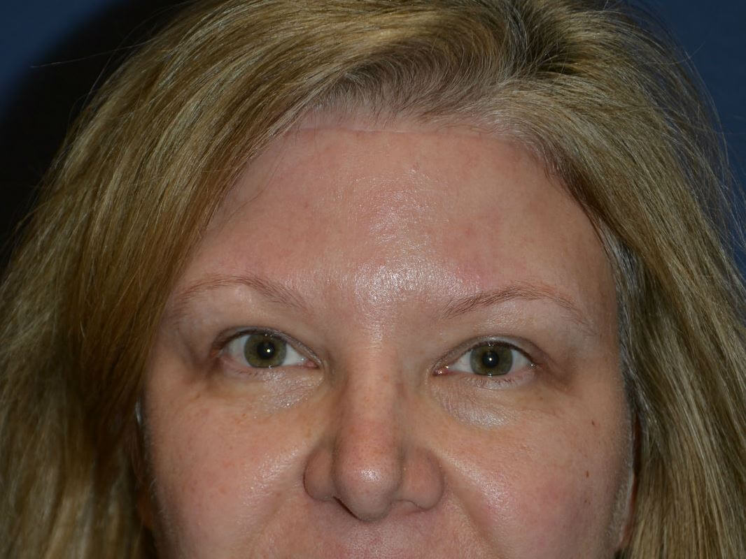 after brow lift female patient front view case 3537