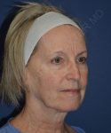 before brow lift female patient right angle view case 3559