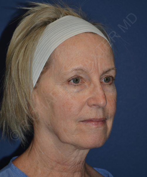 before brow lift female patient right angle view case 3559