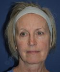 before brow lift female patient front view case 3559