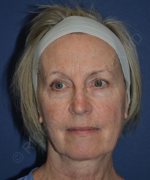 before brow lift female patient front view case 3559