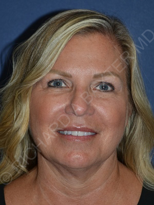 after brow lift front view female patient case 3524