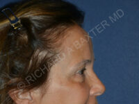 before brow lift female patient right side view case 3542