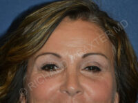 after brow lift female patient front view case 3542