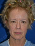 before brow lift female patient front view case 3552