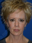 after brow lift female patient front view case 3552