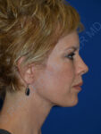 after brow lift female patient right side view case 3552