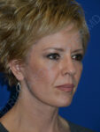 after brow lift female patient right angled view case 3552