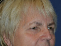 before brow lift female patient right angled view case 3532