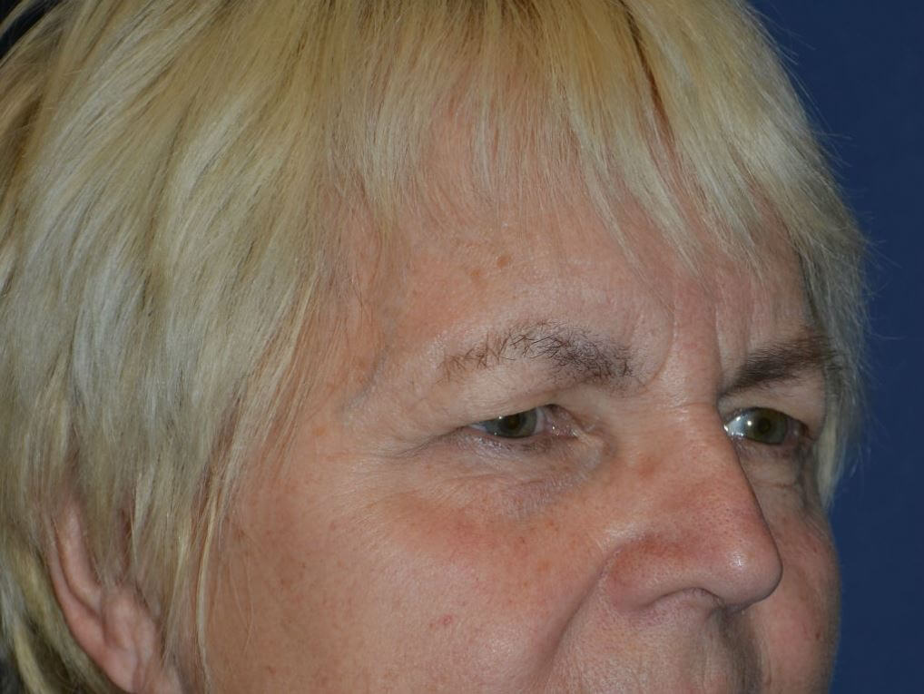 before brow lift female patient right angled view case 3532