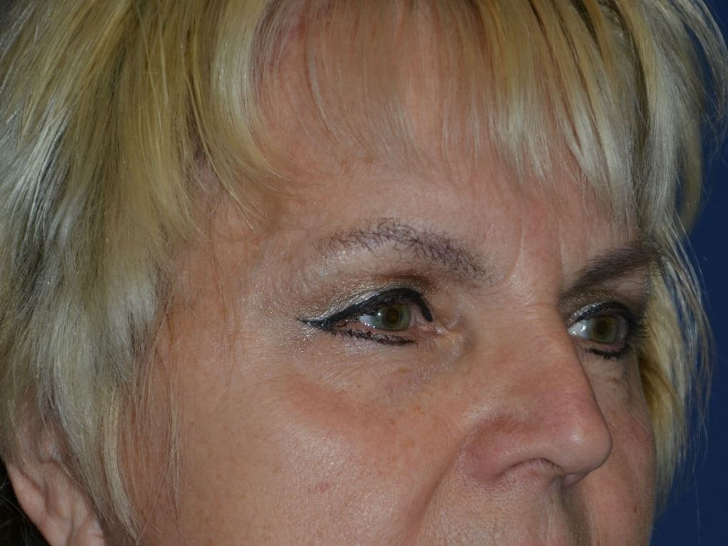 after brow lift female patient right angled view case 3532