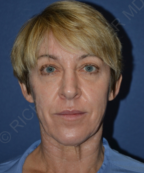 before brow lift female patient front view case 3564