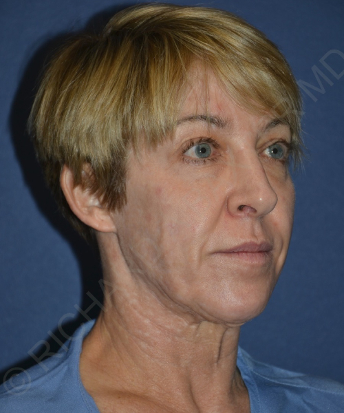 before brow lift female patient right angle view case 3564