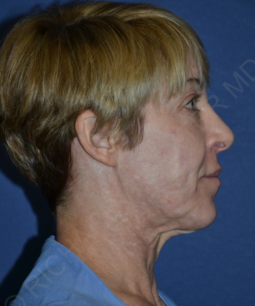 before brow lift female patient right side view case 3564