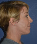 after brow lift female patient right side view case 3564