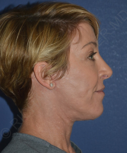 after brow lift female patient right side view case 3564