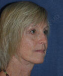 after brow lift female patient right angle view case 3559