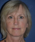 after brow lift female patient front view case 3559