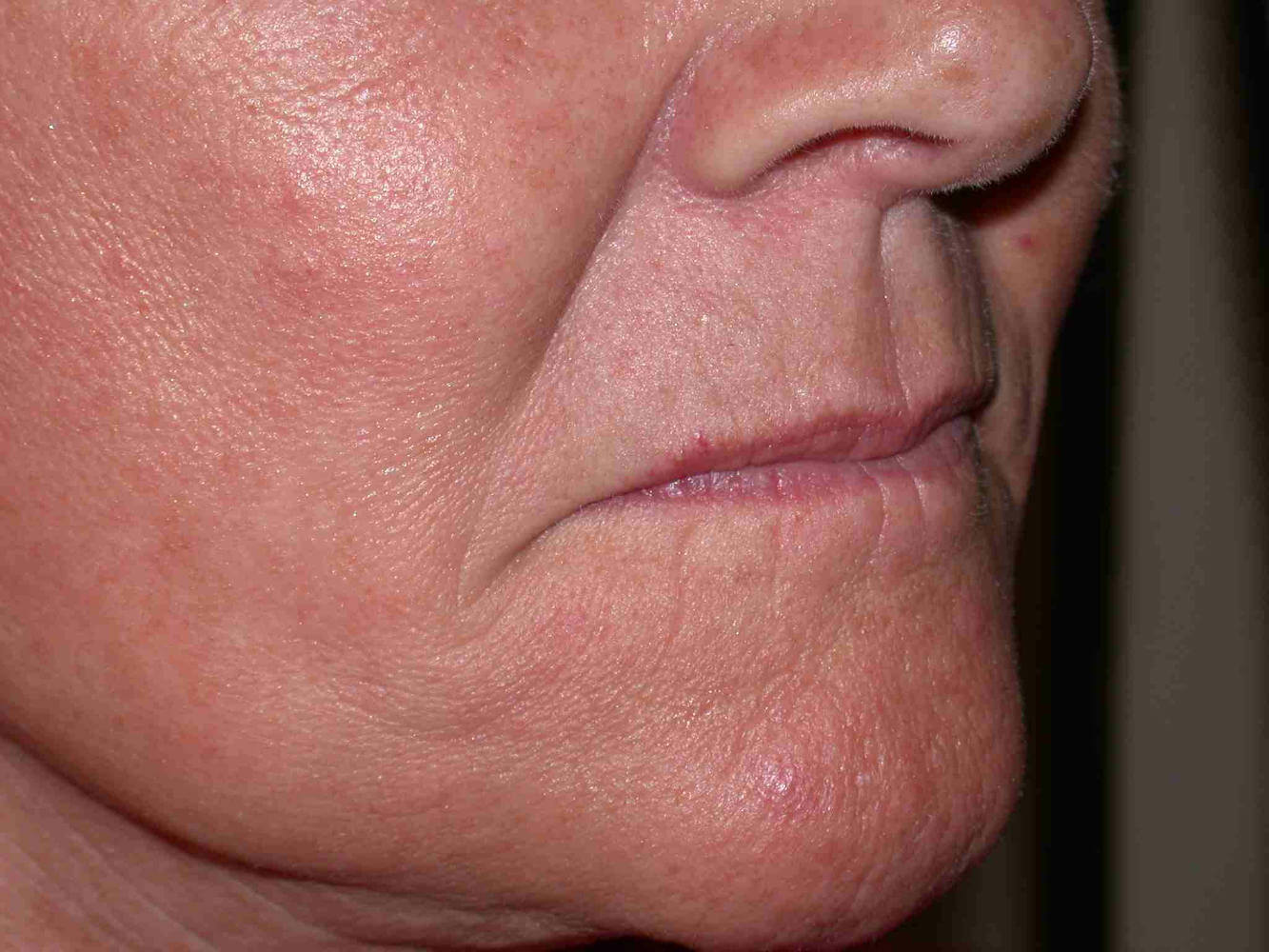 before injectable fillers female patient right angled view case 3105