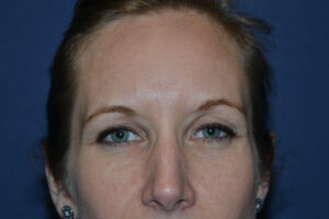 after injectable fillers female patient front view case 3097