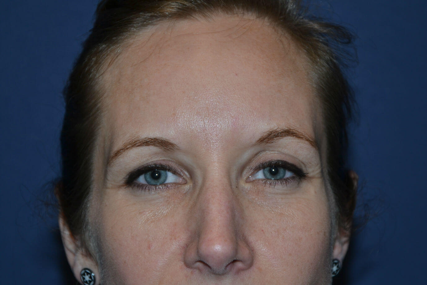 after injectable fillers female patient front view case 3097