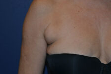 before Kybella treatment female patient front view case 3100