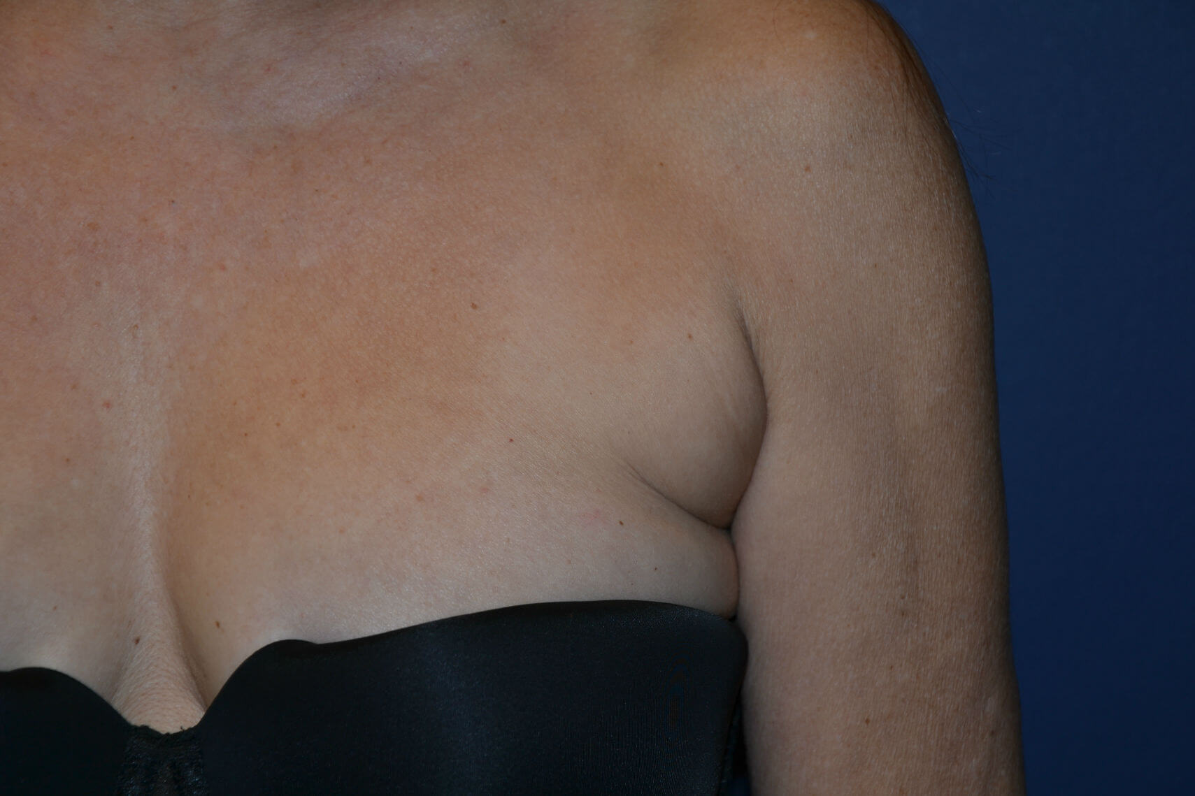 before Kybella treatment female patient front view case 3100