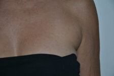after Kybella treatment female patient front view case 3100
