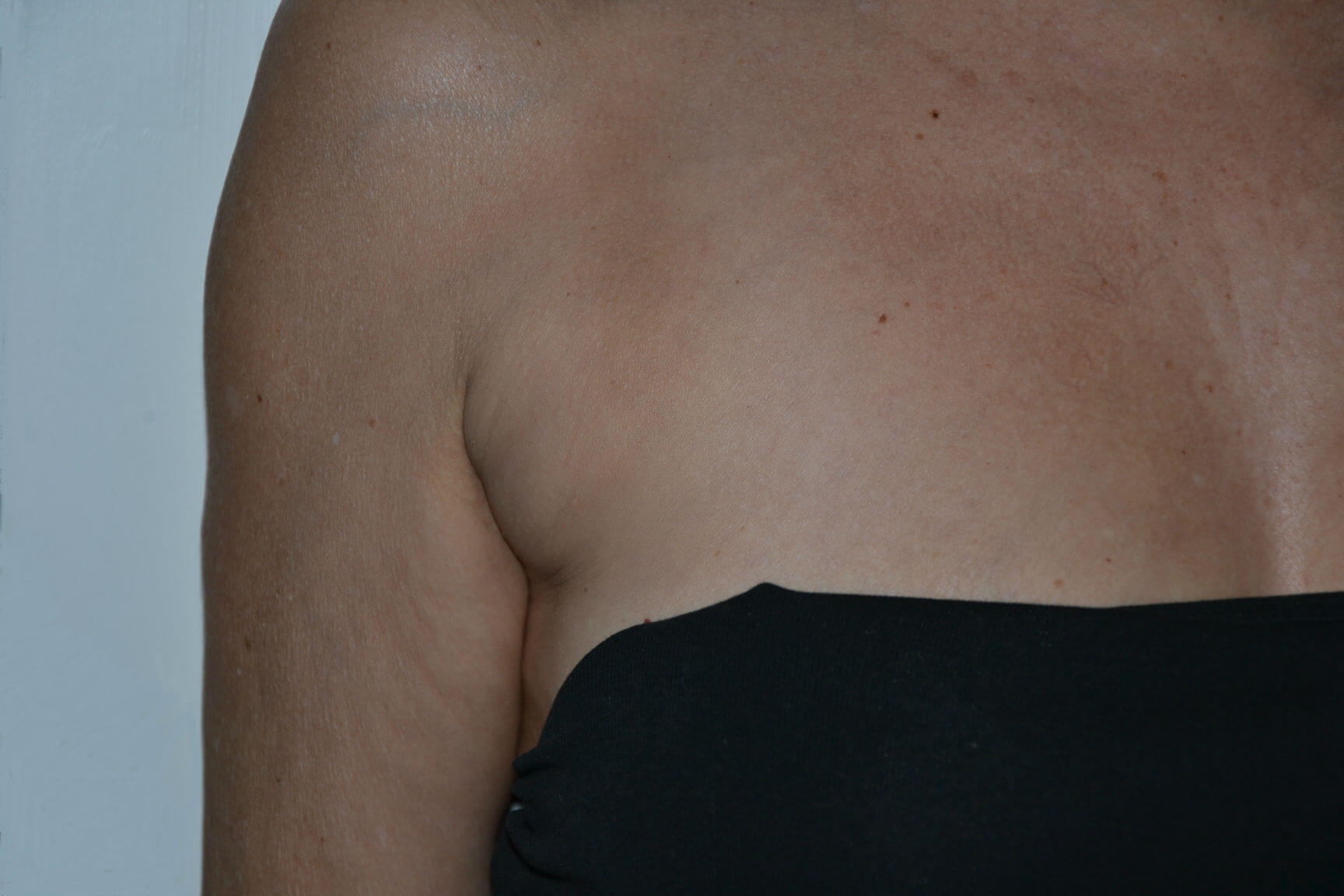 after Kybella treatment female patient front view case 3100