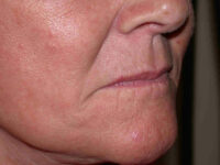 before injectable fillers female patient right angled view case 3105