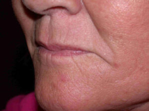 before injectable fillers female patient left angled view case 3105