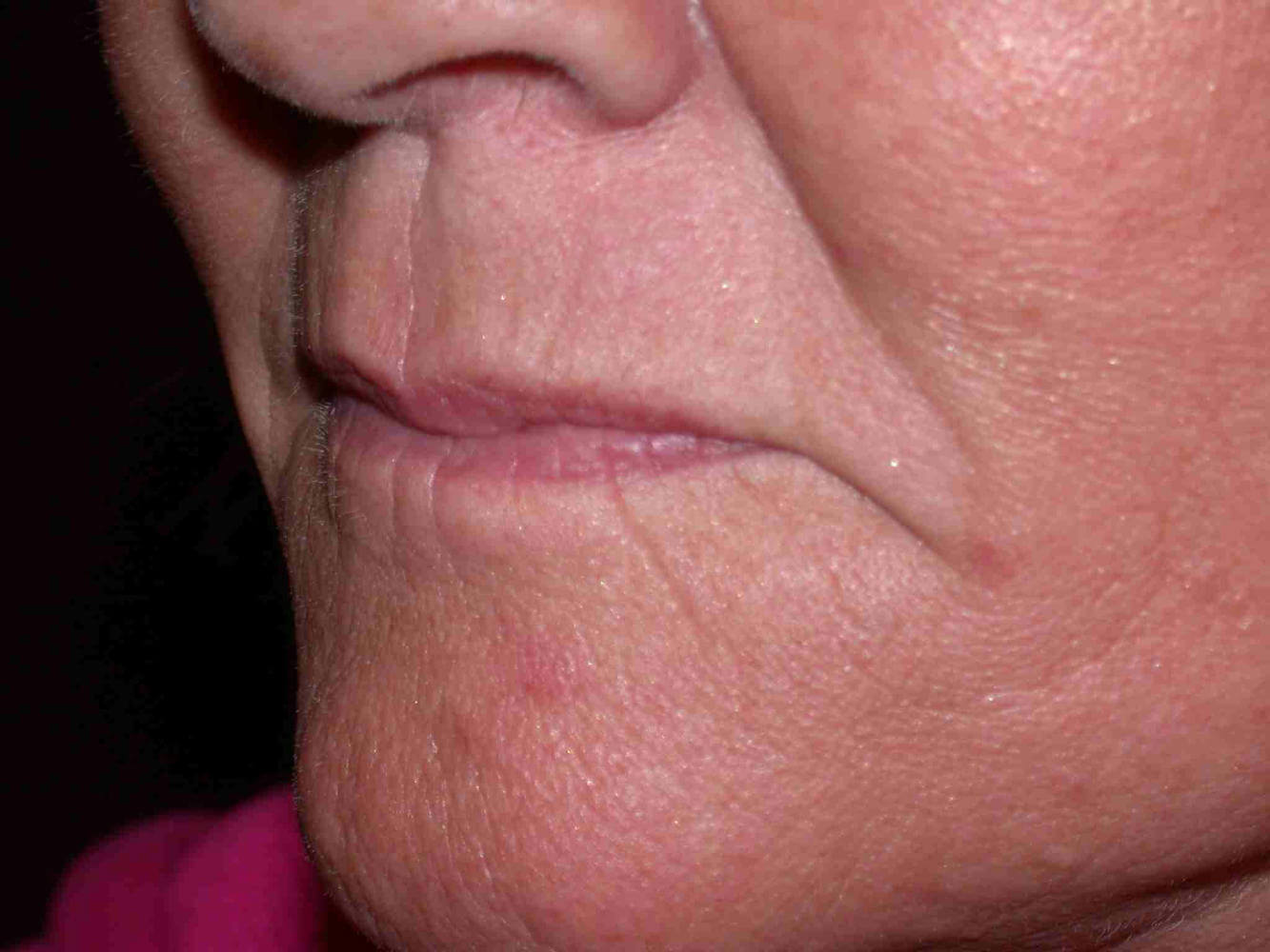 before injectable fillers female patient left angled view case 3105