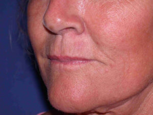 after injectable fillers female patient left angled view case 3105