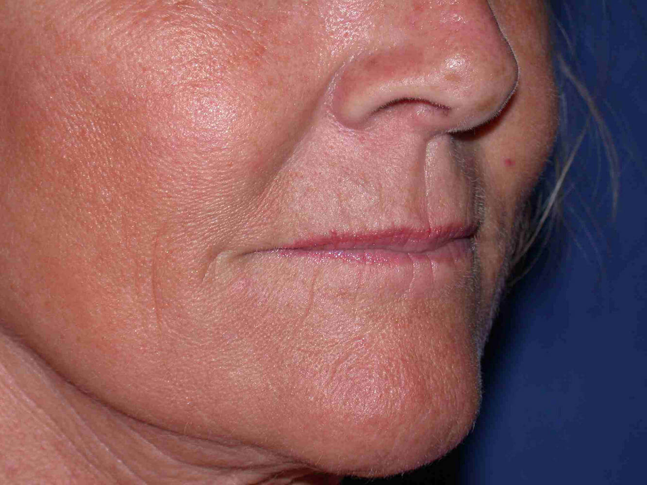 after injectable fillers right angled view case 3105