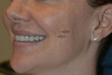 before injectable fillers female patient left angled view case 3110