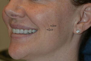before injectable fillers female patient left angled view case 3110