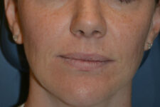 before injectable fillers female patient front view case 3110