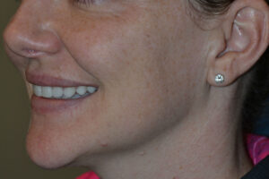 after injectable fillers female patient left angled view case 3110